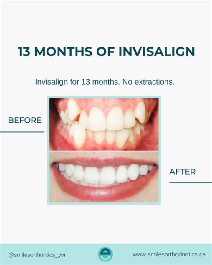 B Simone and Invisalign: A Timeline of Their Relationship