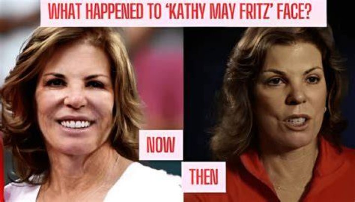 Kathy Fritz: A Journey Through Face Surgery