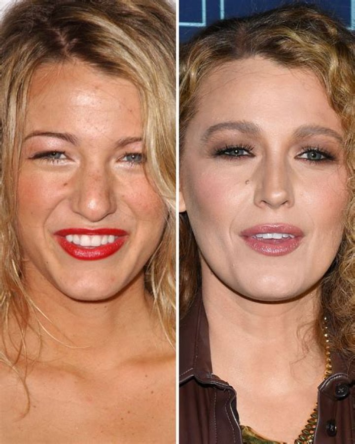 The Evolution of Blake Lively's Beauty: Before and After Nose Job