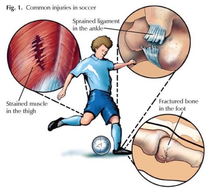 Understanding the Jersey Jon Limp Injury: A Deep Dive