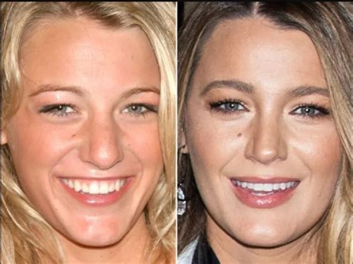 Unveiling the Truth: Blake Lively's Plastic Surgery Journey