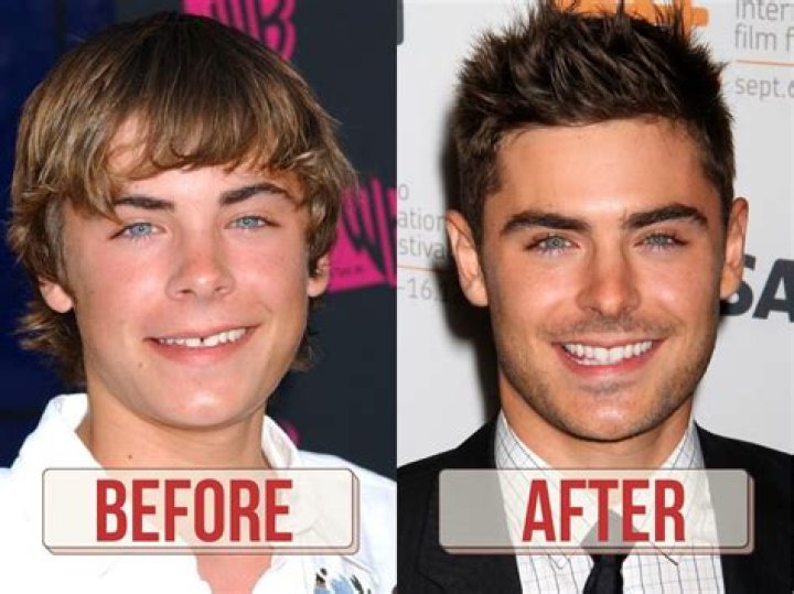 Zac Efron's Plastic Surgery Journey: Before and After